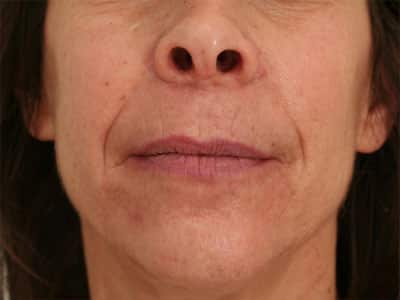 Before Image: Non-surgical – Lips - front