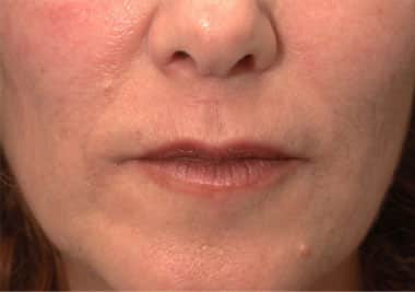 After Image: Non-surgical – Lips - front