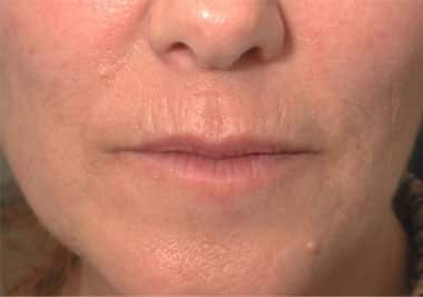 Before Image: Non-surgical – Lips - front