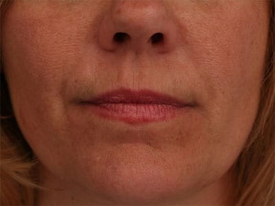 After Image: Non-surgical – Lips - front