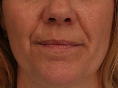 Before Image: Non-surgical – Lips - front