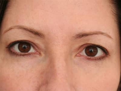 After Image: Non-surgical – Eyes - front