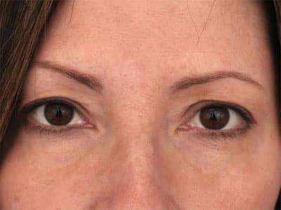 Before Image: Non-surgical – Eyes - front