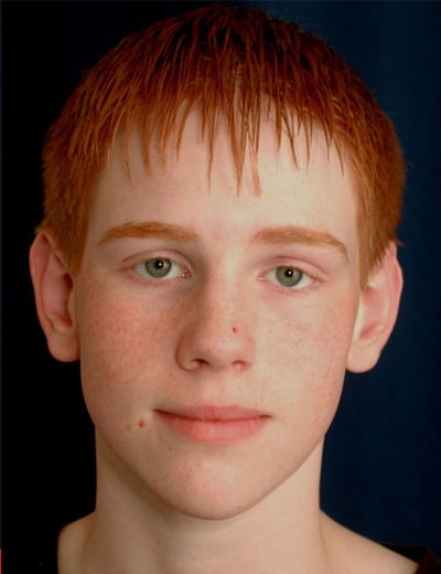 After Image: Otoplasty - front