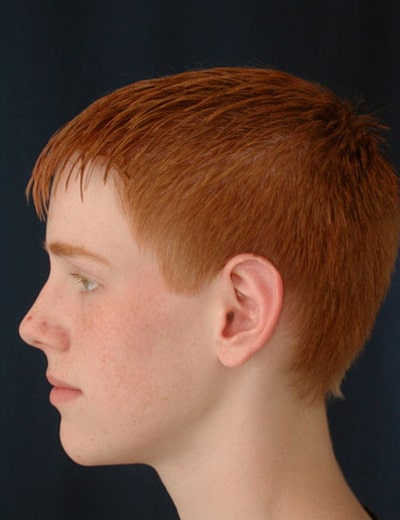 After Image: Otoplasty - left-side