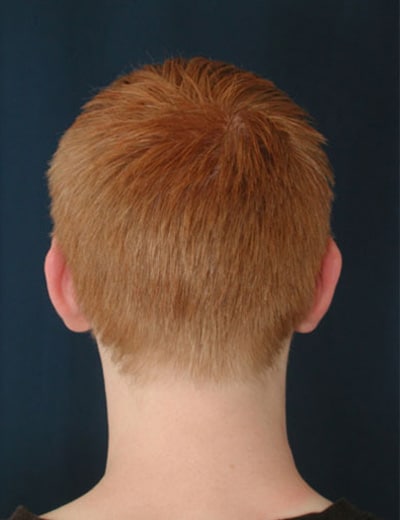 After Image: Otoplasty - back
