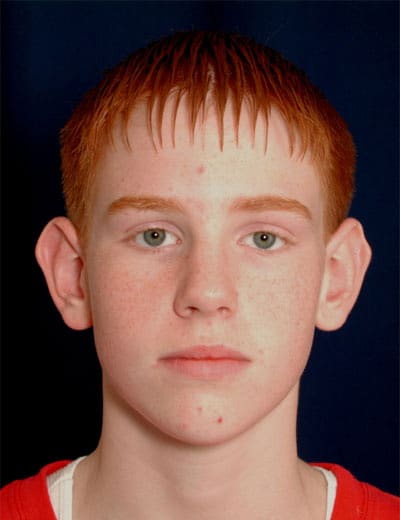 Before Image: Otoplasty - front