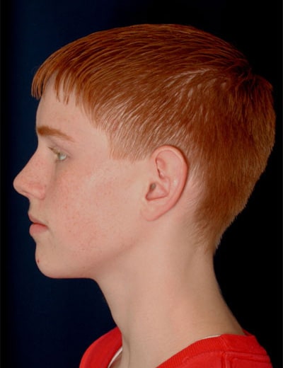 Before Image: Otoplasty - left-side