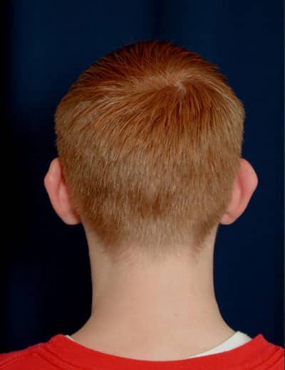 Before Image: Otoplasty - back