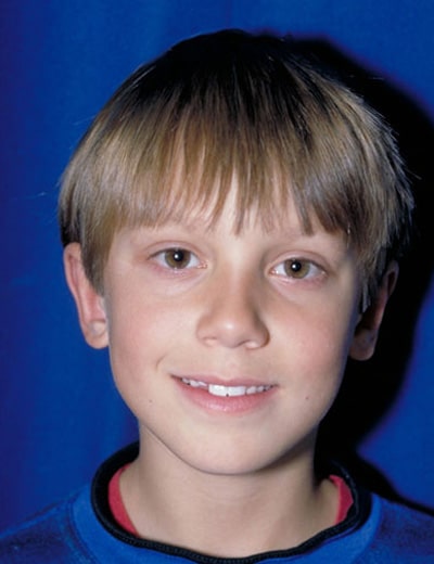 After Image: Otoplasty - front