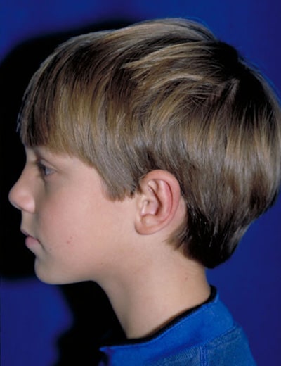 After Image: Otoplasty - left-side