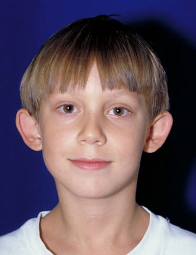 Before Image: Otoplasty - front