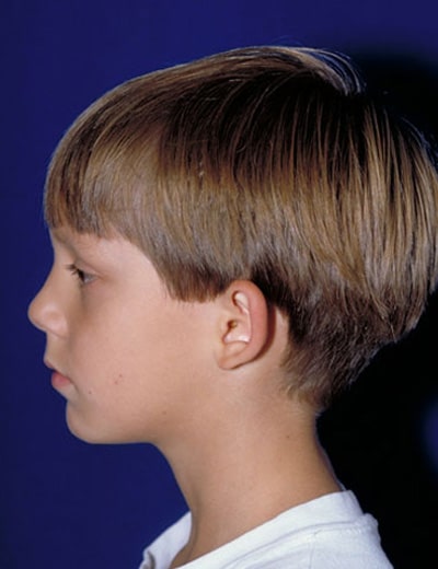 Before Image: Otoplasty - left-side