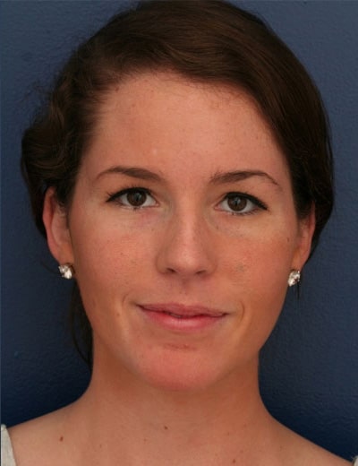 After Image: Otoplasty - front