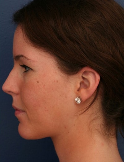 After Image: Otoplasty - left-side