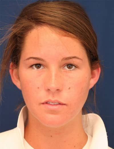 Before Image: Otoplasty - front