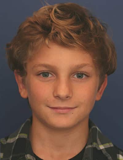 After Image: Otoplasty - front