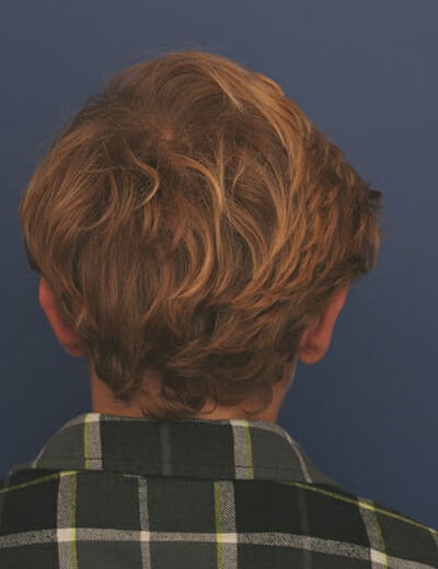 After Image: Otoplasty - back