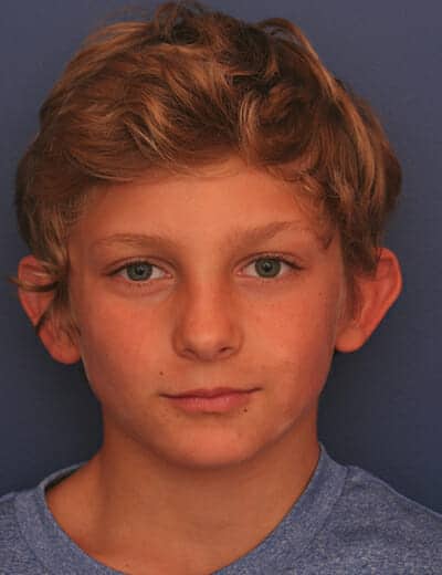 Before Image: Otoplasty - front