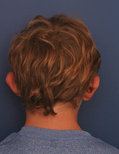 Before Image: Otoplasty - back