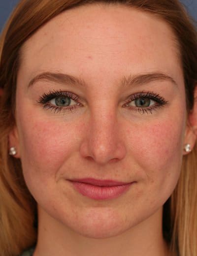 After Image: Rhinoplasty - front
