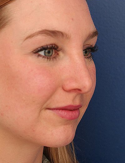 After Image: Rhinoplasty - right-front-oblique