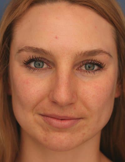 Before Image: Rhinoplasty - front