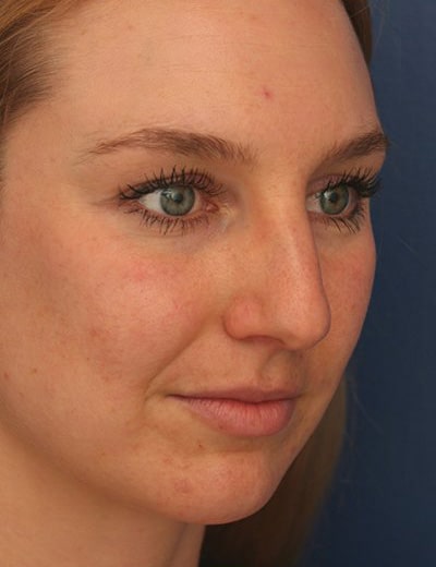 Before Image: Rhinoplasty - right-front-oblique