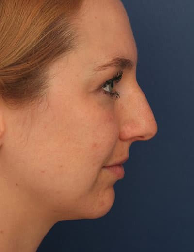 Before Image: Rhinoplasty - right-side