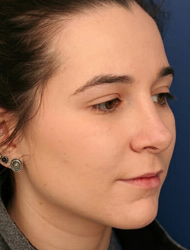 After Image: Rhinoplasty - right-front-oblique