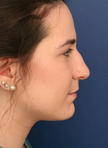 Before Image: Rhinoplasty - right-side