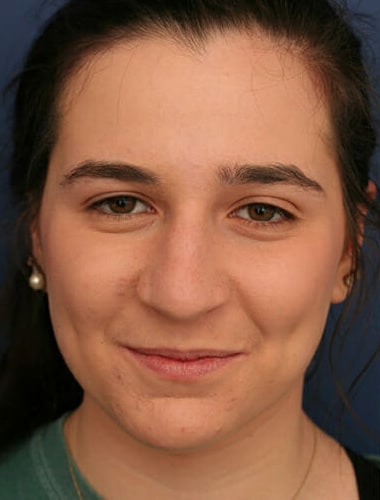 Before Image: Rhinoplasty - front