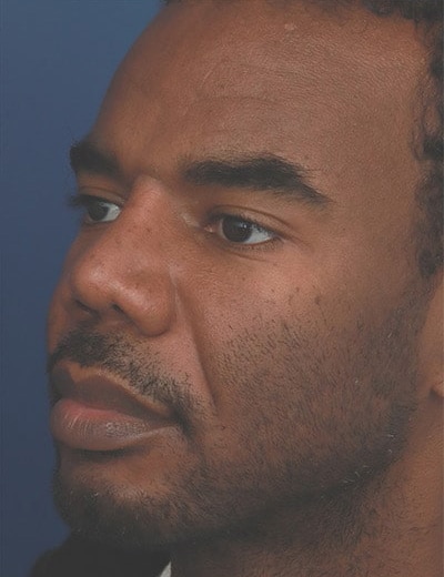 After Image: Ethnic Rhinoplasty - left-front-oblique
