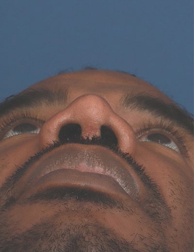 After Image: Ethnic Rhinoplasty - front