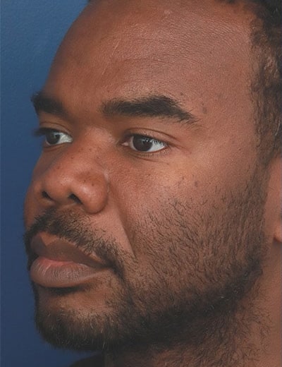 Before Image: Ethnic Rhinoplasty - left-front-oblique