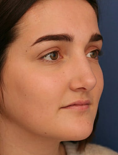 After Image: Rhinoplasty - right-front-oblique