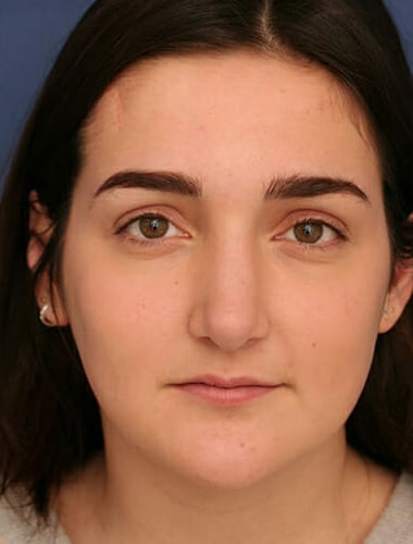After Image: Rhinoplasty - front