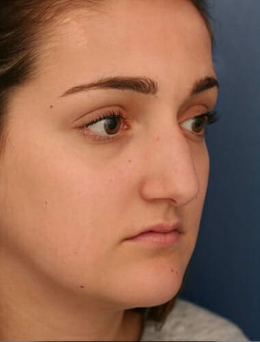 Before Image: Rhinoplasty - right-front-oblique