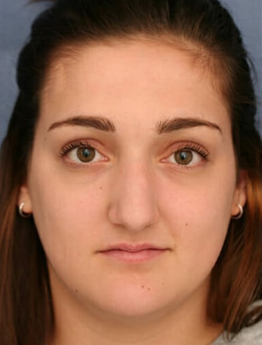 Before Image: Rhinoplasty - front