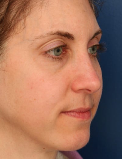 After Image: Rhinoplasty - right-front-oblique