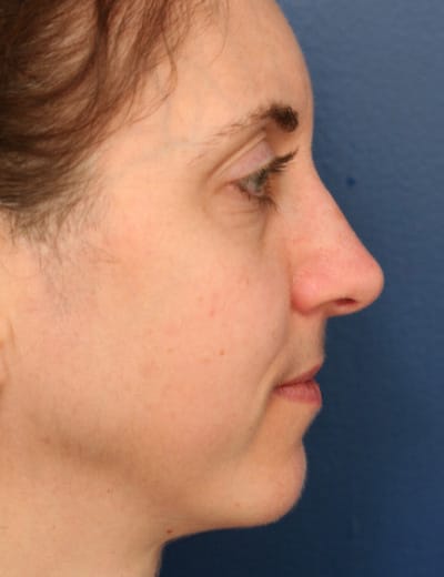 After Image: Rhinoplasty - right-side