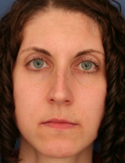 Before Image: Rhinoplasty - front