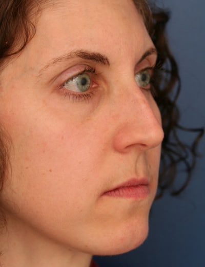 Before Image: Rhinoplasty - right-front-oblique