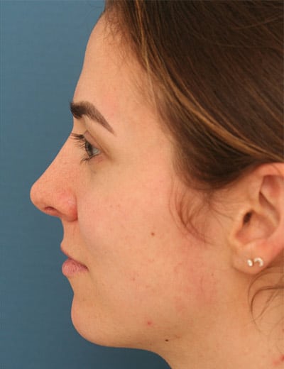 After Image: Rhinoplasty - left-side