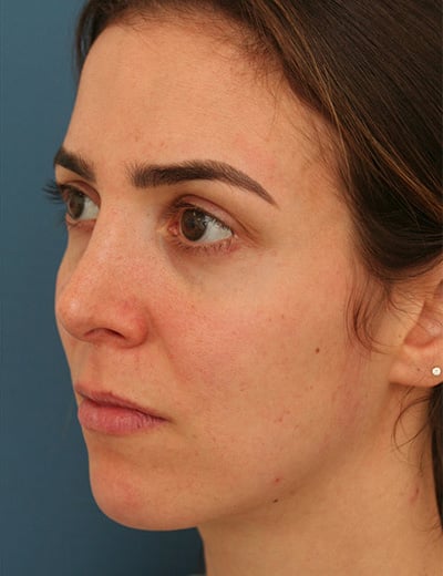 After Image: Rhinoplasty - left-front-oblique