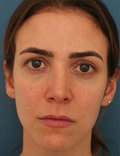 After Image: Rhinoplasty - front