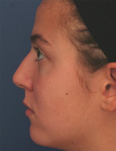 Before Image: Rhinoplasty - left-side