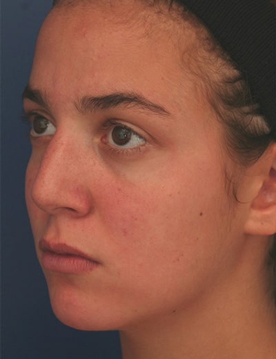 Before Image: Rhinoplasty - left-front-oblique