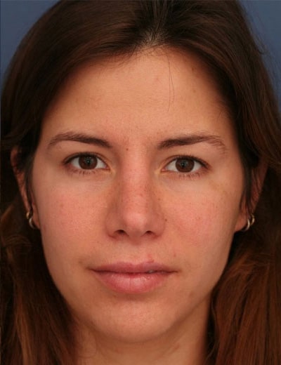After Image: Rhinoplasty - front