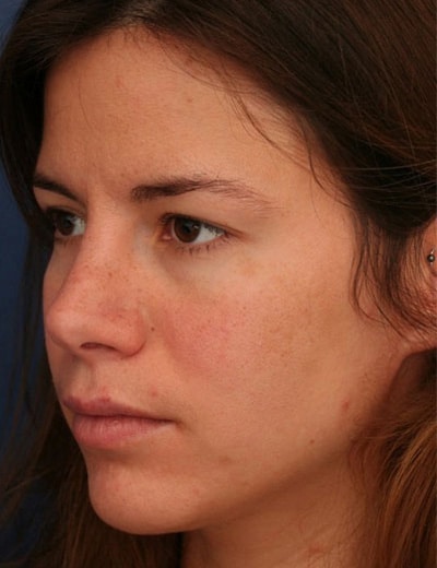 After Image: Rhinoplasty - left-front-oblique